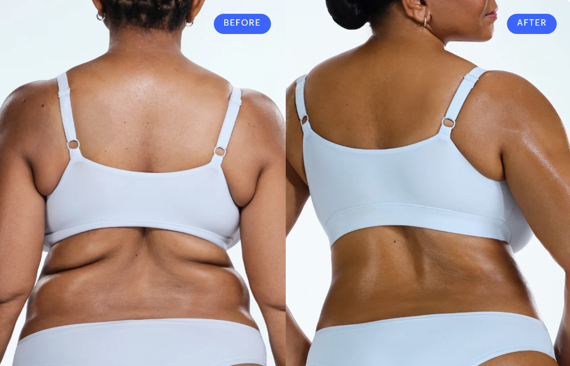 Flanks CoolSculpting